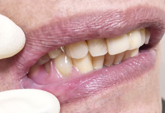 入れ歯に対する共通の悩み