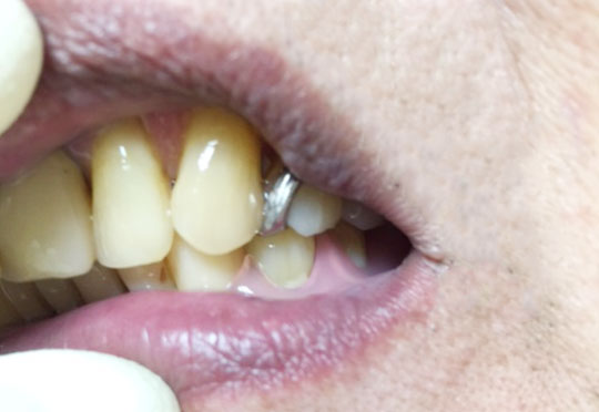 入れ歯に対する共通の悩み
