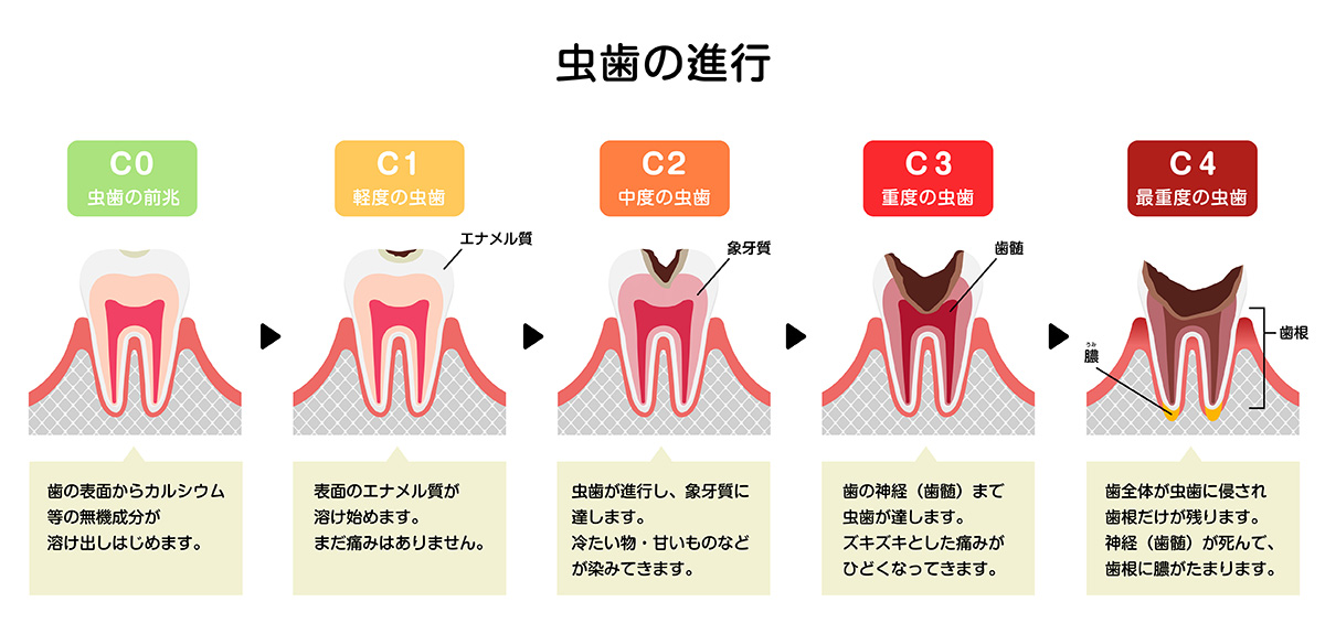 https://takarada-dc.com/wp-content/uploads/2025/09/caries_01.png